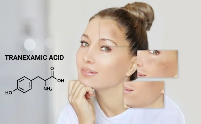 Tranexamic Acid là thành phần được sử dụng trong nhiều sản phẩm điều trị nám