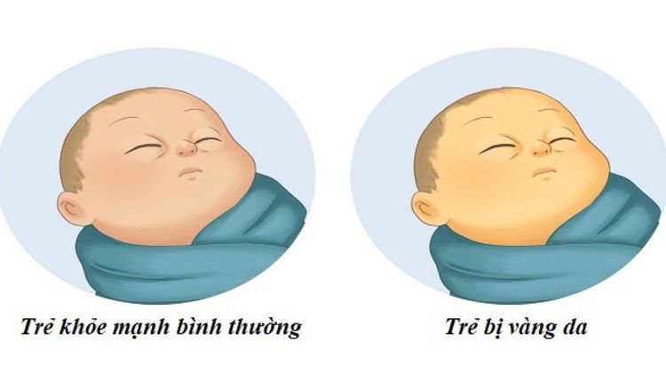 Vàng da ở trẻ sơ sinh