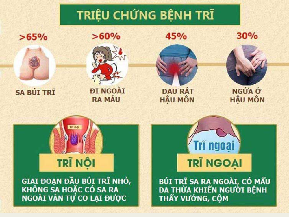 Các triệu chứng thường gặp khi bệnh trĩ