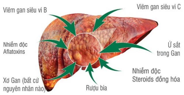 Có nhiều nguyên nhân dẫn đến bệnh vàng da.