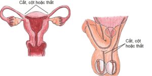 Triệt sản ở nữ giới