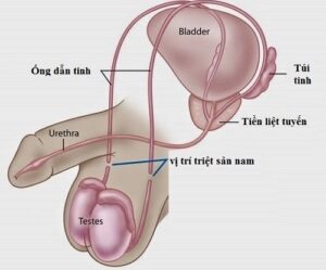 Triệt sản ở nam 