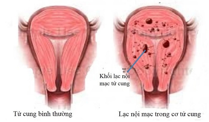 triệu chứng lạc nội mạc tử cung