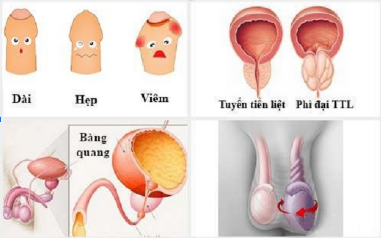 Vô sinh ở nam giới.