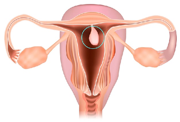 Polyp tử cung là một trong những vấn đề phụ khoa phổ biến mà nhiều phụ nữ phải đối mặt