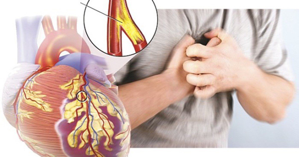 Tức ngực là biểu hiện của bệnh tim mạch vành