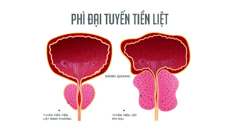 Tuyến tiền liệt phì đại và tuyến tiền liệt bình thường