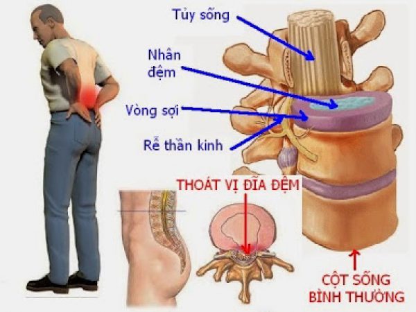 Hình ảnh thoát vị đĩa đệm ở bệnh nhân.