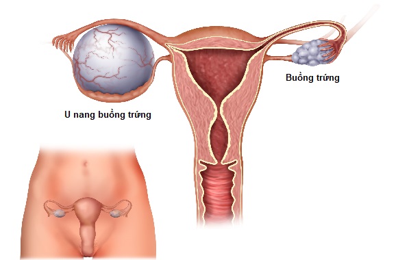 Bệnh U Nang Là Gì? Nguyên Nhân, Triệu Chứng Và Phương Pháp Điều Trị Hiệu Quả