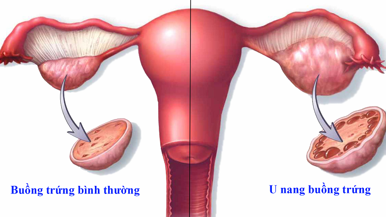 Hình ảnh minh họa bệnh u nang buồng trứng