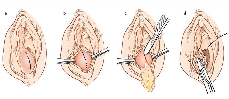 Điều trị U nang tuyến Bartholin