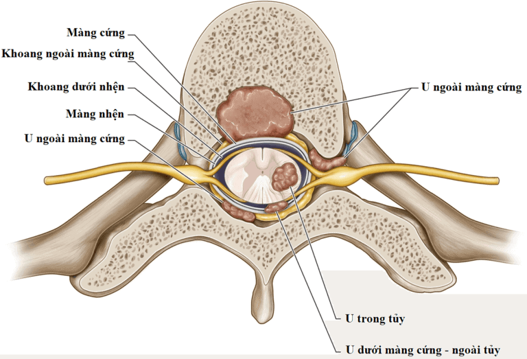 Tổng quan chung u trong ống sống.
