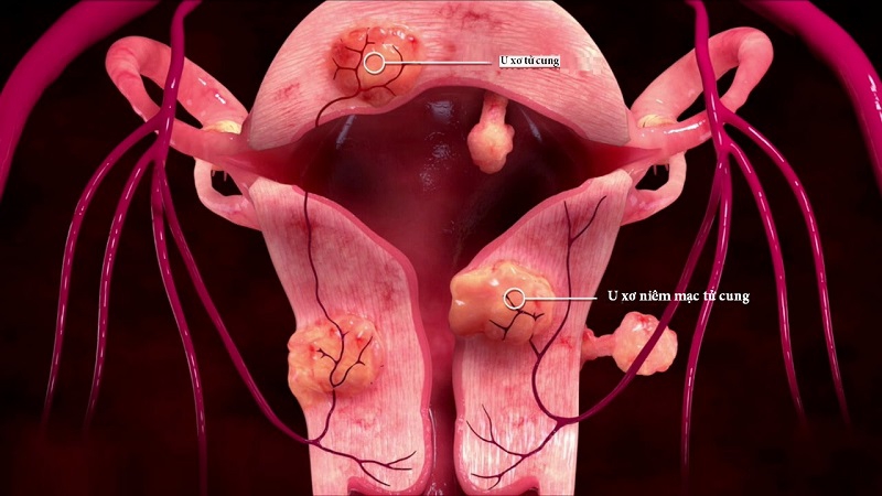 U xơ tử cung là các khối u lành tính phát triển từ mô cơ tử cung. 