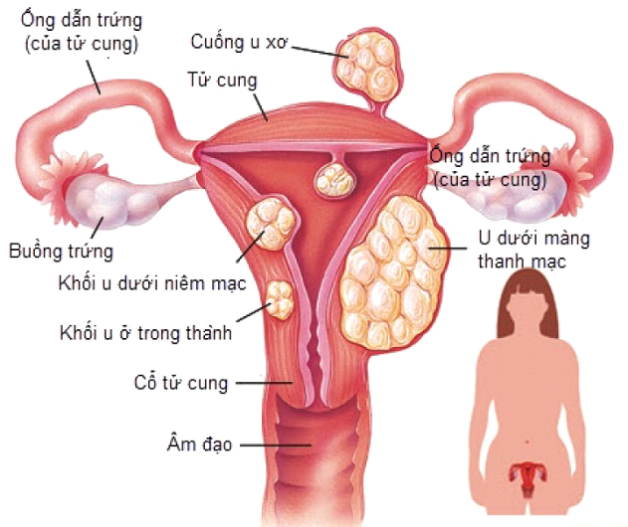 U xơ tử cung có thể xuất hiện với số lượng, kích thước và vị trí khác nhau.