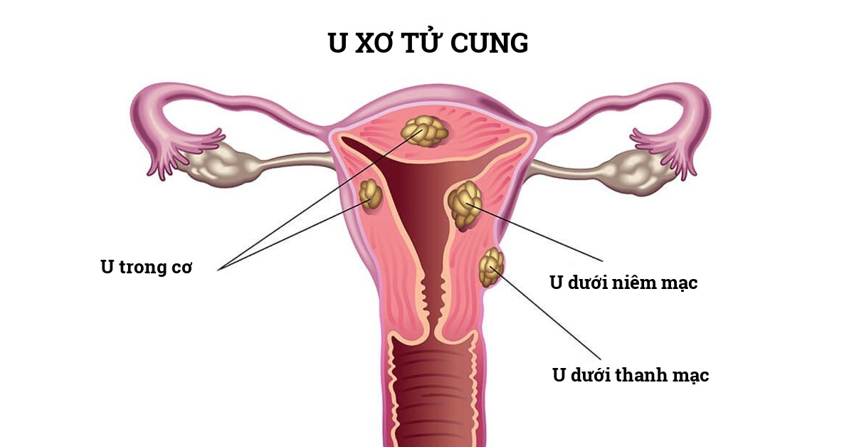 Các vị trí u xơ tử cung thường gặp