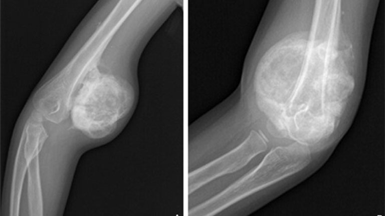 Chẩn đoán u xương