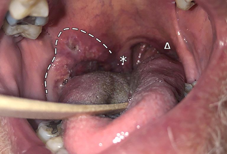 Dấu hiệu cảnh báo sớm ung thư amidan 