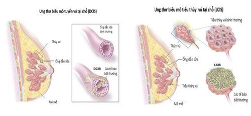 Hình ảnh mô phỏng cấu trúc khối u trong ung thư biểu mô tuyến vú thể dị sản