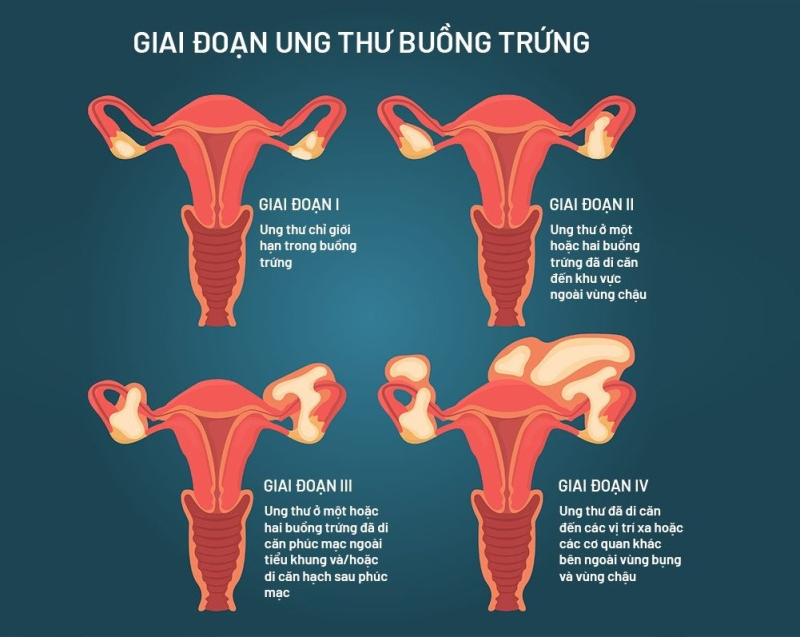 Các giai đoạn ung thư buồng trứng