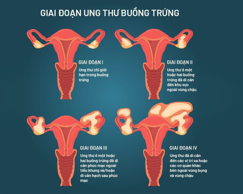 DẤU HIỆU UNG THƯ BUỒNG TRỨNG GIAI ĐOẠN ĐẦU CẦN CẢNH GIÁC