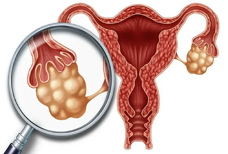 Ung thư buồng trứng: kẻ hủy diệt thầm lặng của phụ nữ