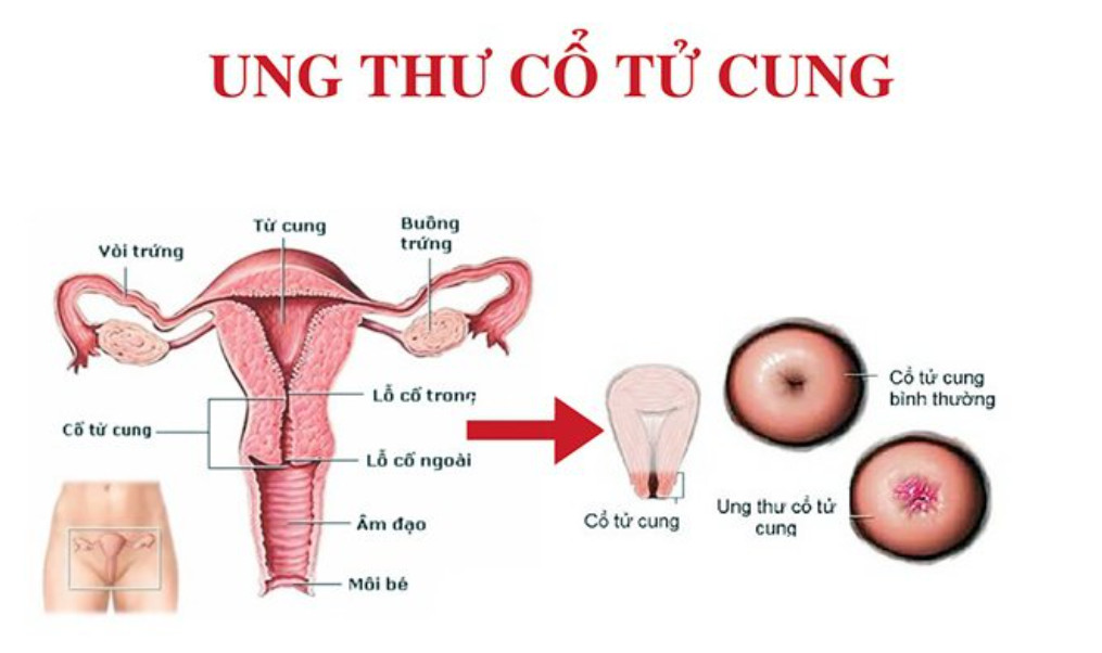 Trẻ tuổi không hoàn toàn loại trừ được nguy cơ mắc bệnh lý cổ tử cung
