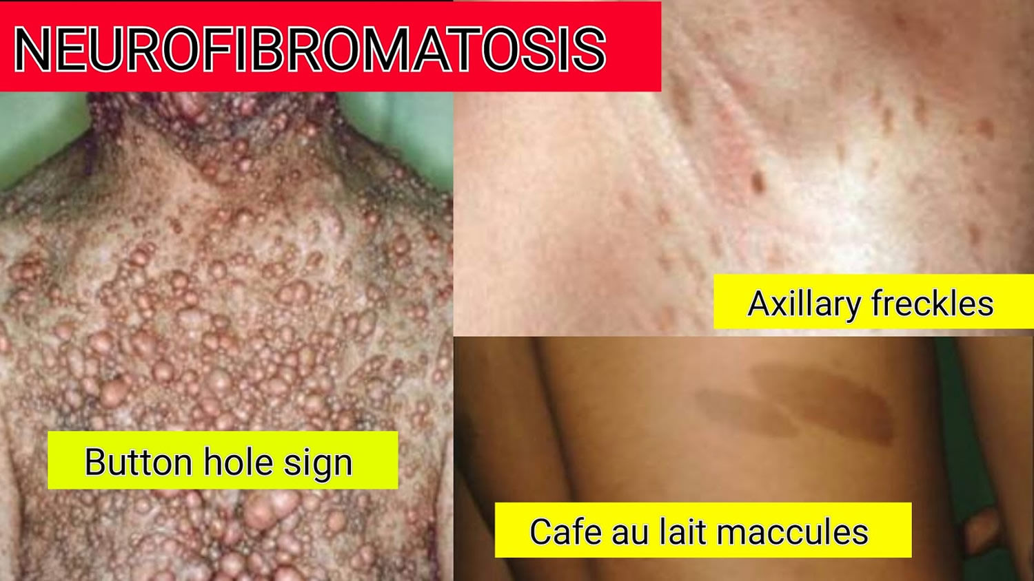 Hội chứng Neurofibromatosis có thể là nguyên nhân gây ung thư não