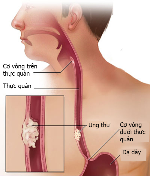 Bị ung thư thanh quản sống được bao lâu?