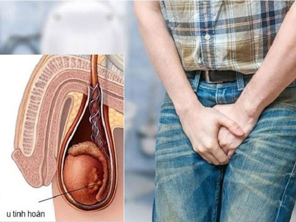 Đau âm ỉ vùng bẹn bìu hoặc vùng bụng dưới là triệu chứng của ung thư tinh hoàn