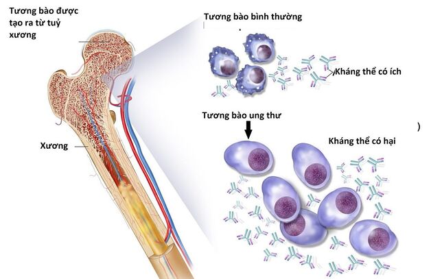 điều tị ung thư tủy