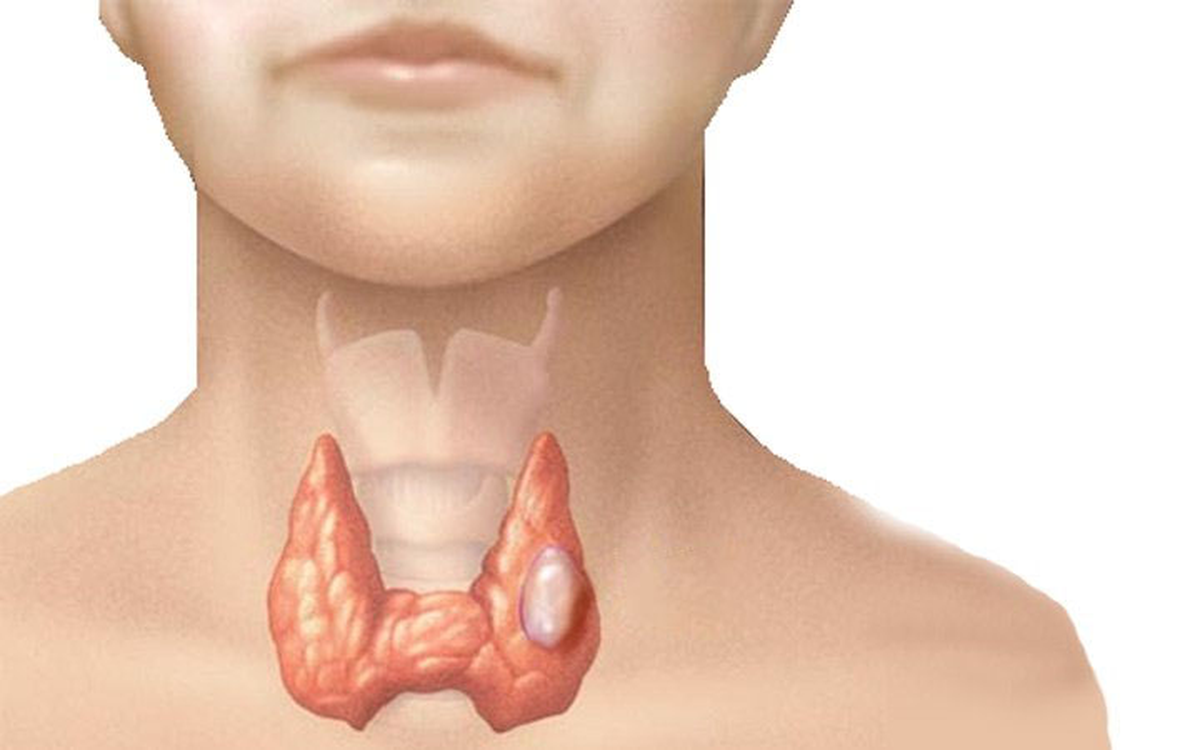 Cách ngăn ngừa ung thư tuyến giáp tái phát