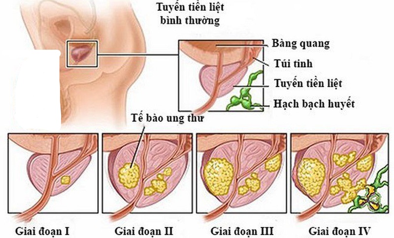 Ung thư tuyến tiền liệt thường gặp