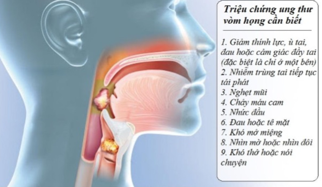 Dấu hiệu nghi ngờ ung thư vòm họng khi tự kiểm tra