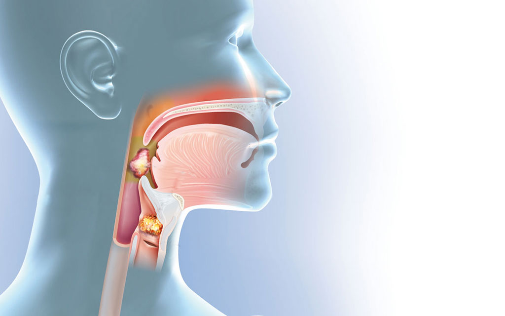 Chẩn đoán ung thư vòm họng giai đoạn đầu