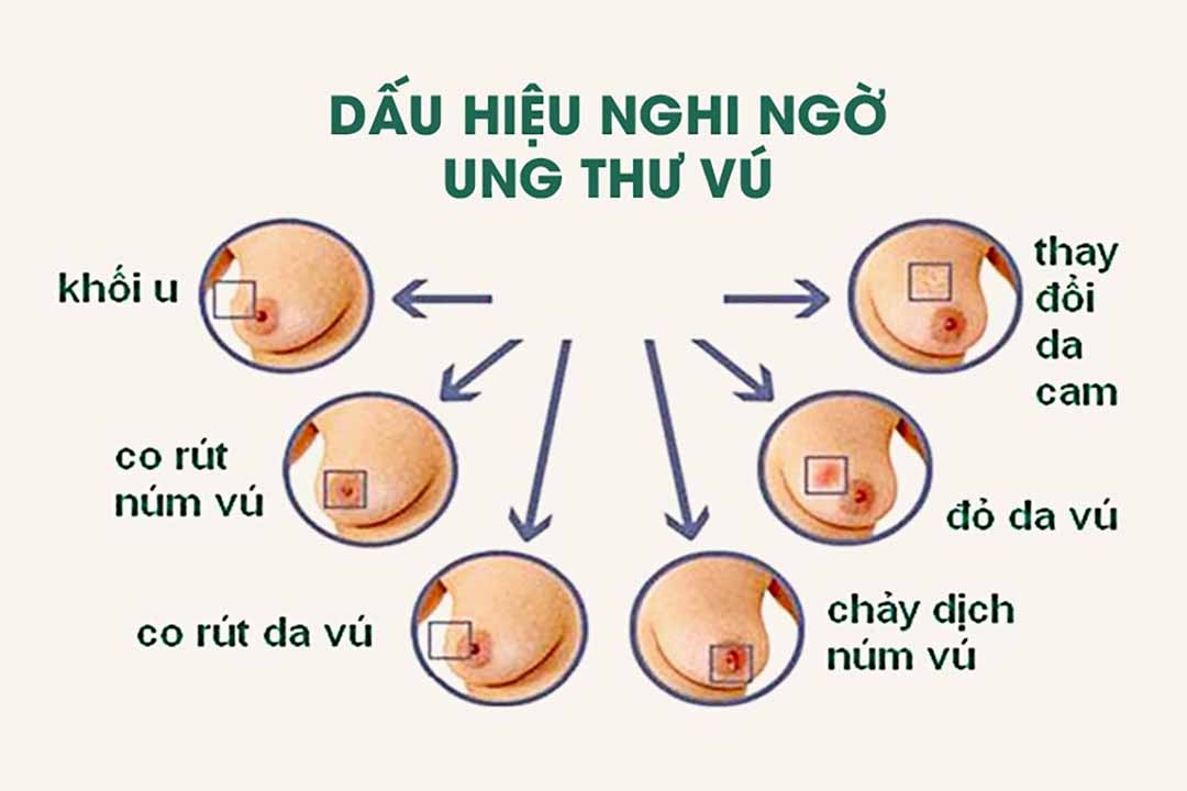 Nhận biết sớm các thay đổi bất thường ở vú giúp tăng cơ hội điều trị