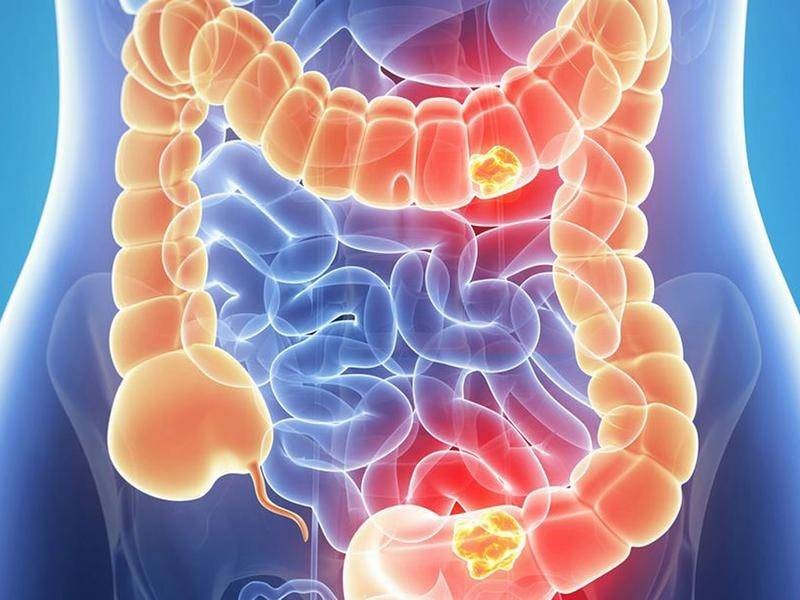 Hiểu rõ về ung thư ruột kết: triệu chứng, nguyên nhân và cách điều trị