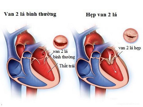 Minh hoạ về hẹp van 2 lá