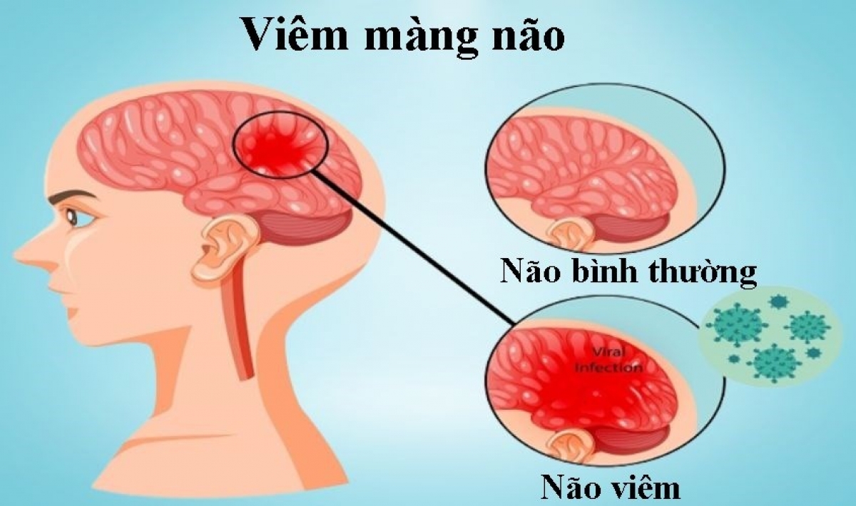 Viêm màng não là bệnh lý thần kinh nguy hiểm ảnh hưởng đến màng não và tủy sống