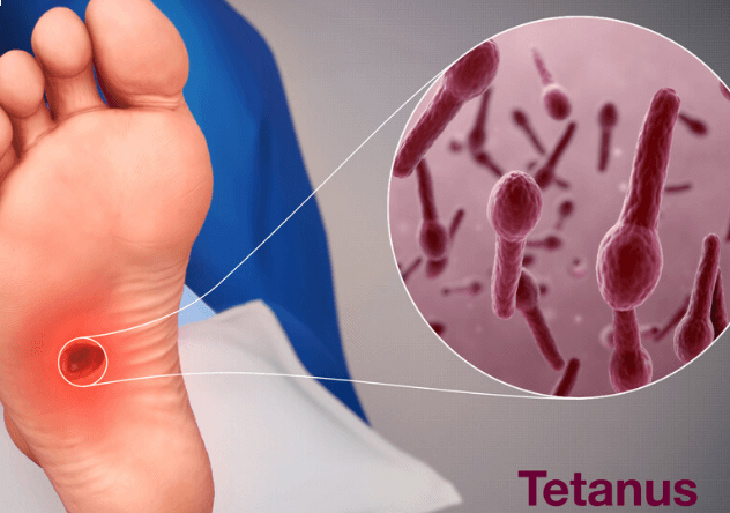 Vi khuẩn Clostridium tetani gây ra bệnh uốn ván