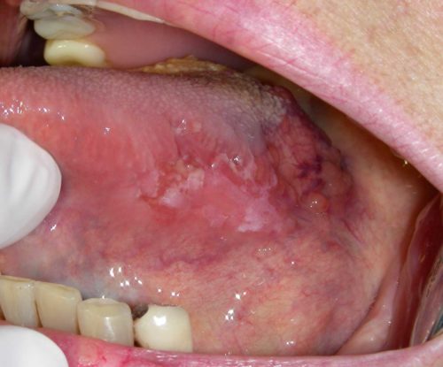 HÌNH ẢNH LƯỠI XUẤT HIỆN VẾT LOÉT NHỎ Ở MÉP LƯỠI GIAI ĐOẠN ĐẦU