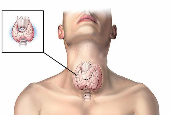 Càng ngày số lượng người mắc ung thư tuyến giáp càng tăng