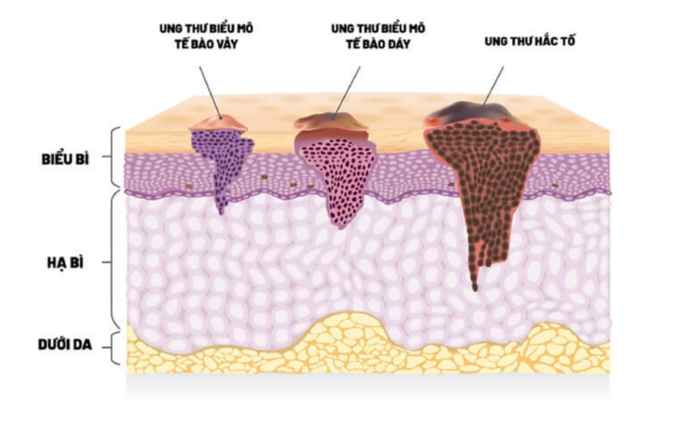 Một số loại ung thư da