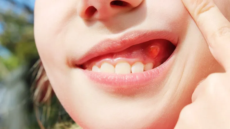 Tình trạng viêm nướu có thể khiến nướu răng sưng đỏ, đau nhức và hình thành mộng răng nếu không được chăm sóc đúng cách.