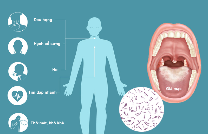 Triệu chứng bệnh bạch hầu ở người lớn