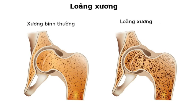 Thiếu Canxi gây loãng xương