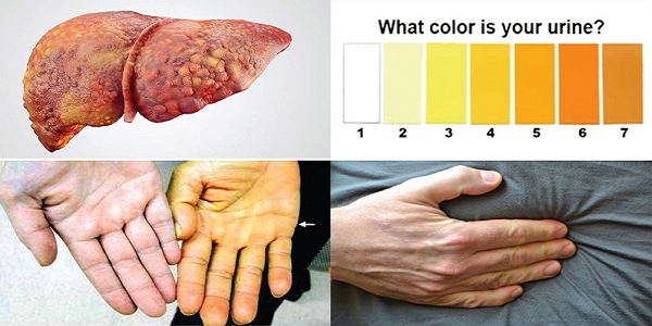 Vàng da và mệt mỏi là những dấu hiệu cần thực hiện xét nghiệm men gan ngay
