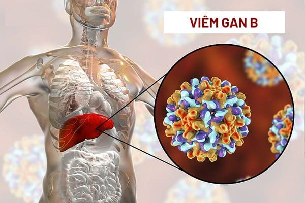 Viêm gan B là một bệnh nhiễm trùng gan nghiêm trọng do virus viêm gan B (HBV) gây ra.