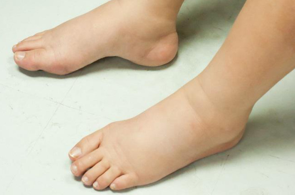 Phù là một trong các triệu chứng của viêm cầu thận
