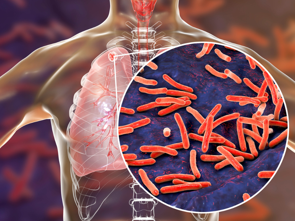 Bệnh lao hô hấp gây ra bởi Vi khuẩn Mycobacterium tuberculosis