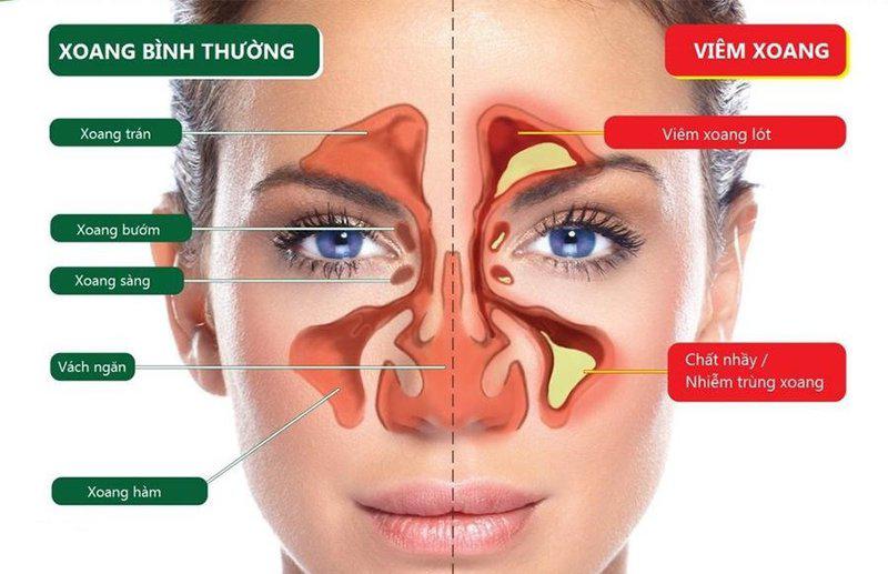 Viêm xoang thường liên quan mật thiết đến viêm mũi.